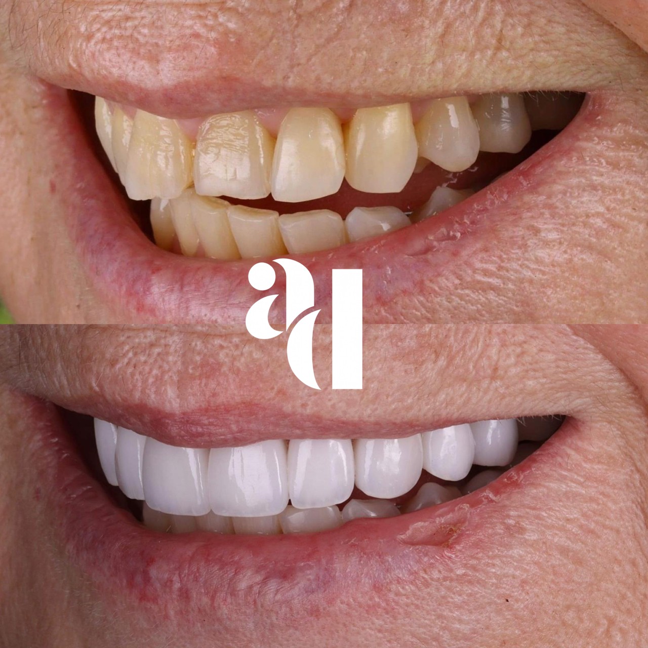 Porcelain veneers candidate smiling