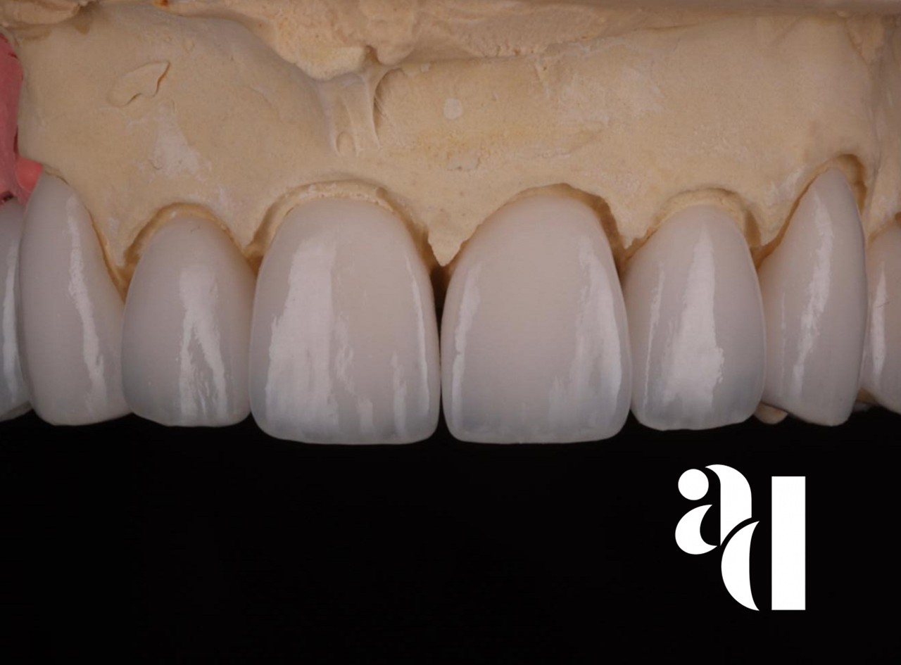 Porcelain and zirconia dental crowns on a model, custom crowns and bridges at Avira Dental